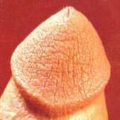 Гиперкератоз головки обрезанного полового члена