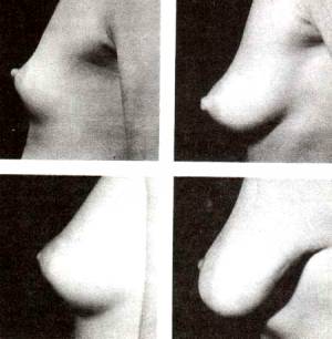 Различные формы женской груди