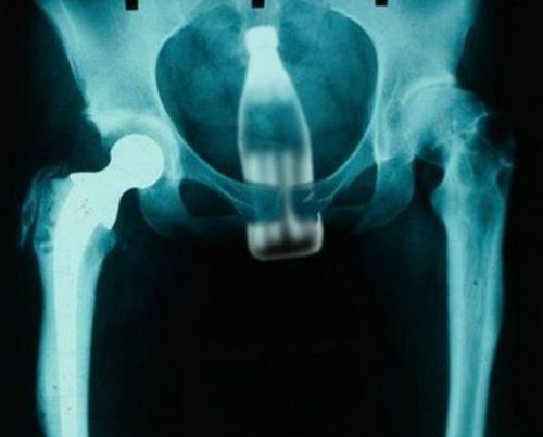 Картинка с рентгеновской фотографией  бутылки во влагалище. картинка ню, акт, прикол