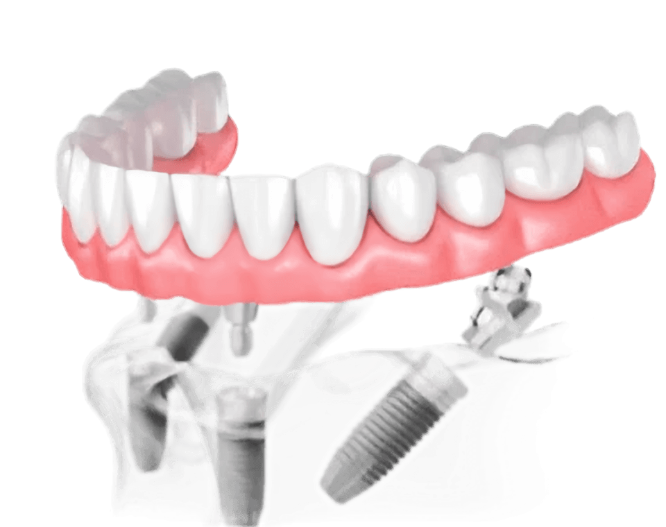 Одномоментная имплантация: Улыбка за один день без компромиссов